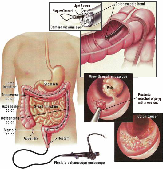 What happens during a colonoscopy?